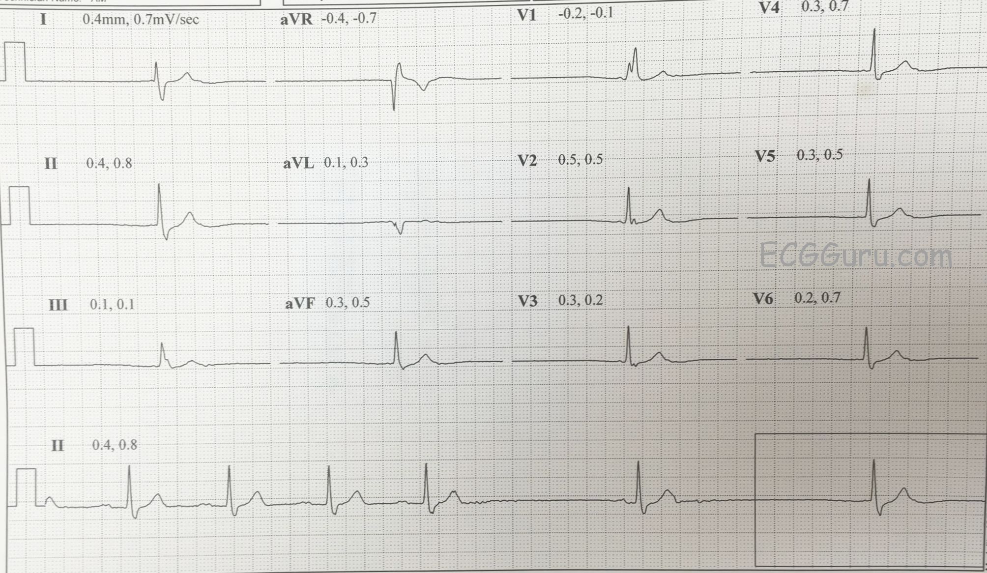 an-irregular-bradycardia-ecg-guru-instructor-resources